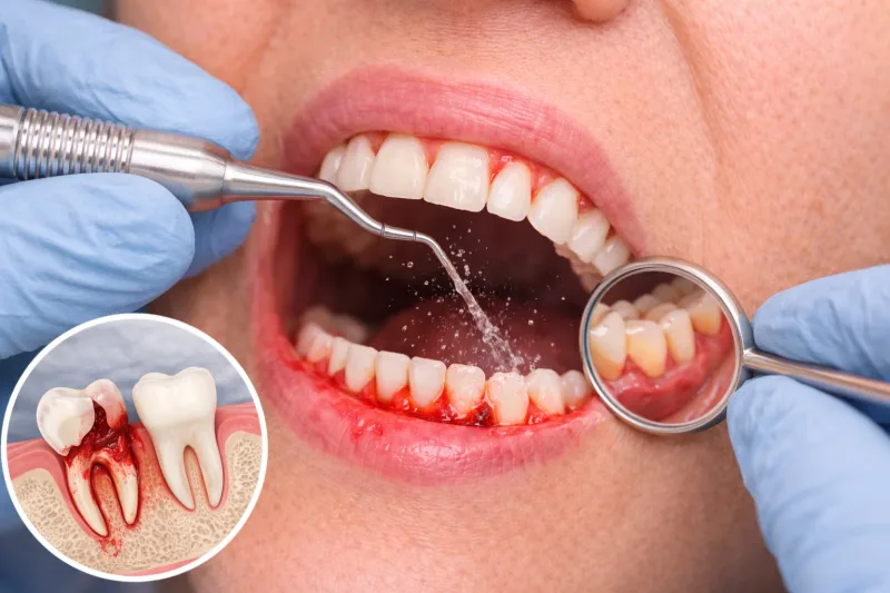 Gum Disease Treatment at Carewell Dental